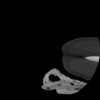 SPORK, NICO - 22.03.1976 - 02.08.2022 - CT obere Extremität - 17:51:17